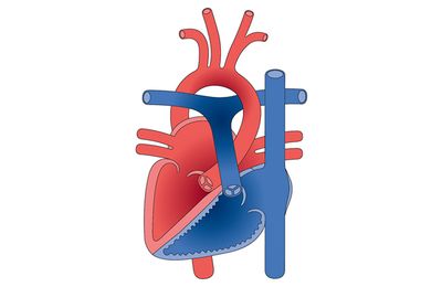 Congenital heart disease