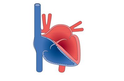 Congenital heart disease