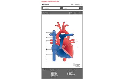 Congenital heart disease